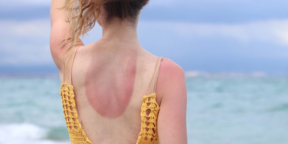 How can I protect my skin from sun damage naturally?