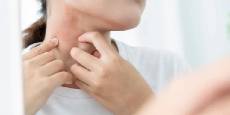 What are the natural ways to prevent skin rashes?